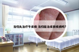 当归丸治疗牛皮癣 当归能治皮肤疾病吗?