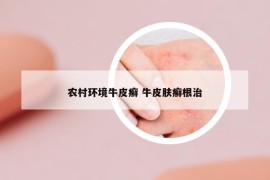 农村环境牛皮癣 牛皮肤癣根治