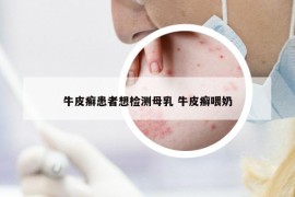 牛皮癣患者想检测母乳 牛皮癣喂奶