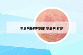 银屑病胳膊肘变形 银屑病 肘部