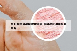 兰州看银屑病医院在哪里 银屑病兰州哪里看的好