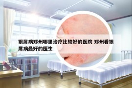 银屑病郑州哪里治疗比较好的医院 郑州看银屑病最好的医生
