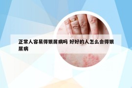 正常人容易得银屑病吗 好好的人怎么会得银屑病