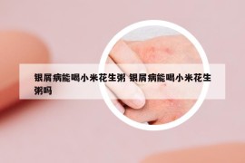 银屑病能喝小米花生粥 银屑病能喝小米花生粥吗
