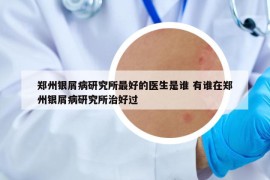 郑州银屑病研究所最好的医生是谁 有谁在郑州银屑病研究所治好过