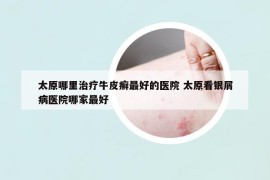 太原哪里治疗牛皮癣最好的医院 太原看银屑病医院哪家最好
