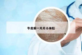 牛皮癣一片片小米粒