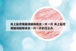 身上起疙瘩越挠越痒而且一片一片 身上起疙瘩越挠越痒而且一片一片的怎么办