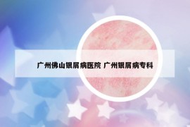 广州佛山银屑病医院 广州银屑病专科