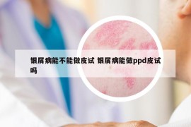 银屑病能不能做皮试 银屑病能做ppd皮试吗