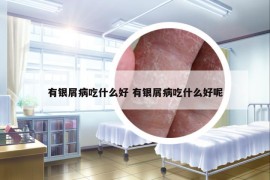 有银屑病吃什么好 有银屑病吃什么好呢