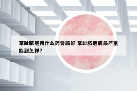 掌趾脓胞用什么药膏最好 掌趾脓疱病最严重能到怎样?