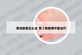 掌治脓疱怎么治 掌踀脓疱病中医治疗