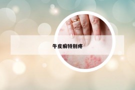 牛皮癣特别疼