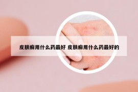皮肤癣用什么药最好 皮肤癣用什么药最好的
