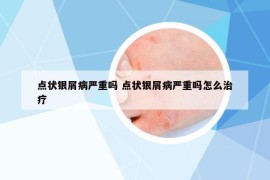 点状银屑病严重吗 点状银屑病严重吗怎么治疗