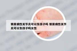 银屑病性关节炎可以生孩子吗 银屑病性关节炎可以生孩子吗女性