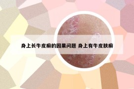 身上长牛皮癣的因果问题 身上有牛皮肤癣