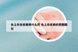 头上长白皮癣用什么药 头上白皮癣的初期图片