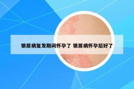 银屑病复发期间怀孕了 银屑病怀孕后好了