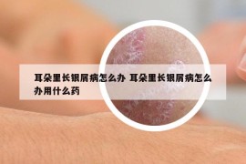耳朵里长银屑病怎么办 耳朵里长银屑病怎么办用什么药