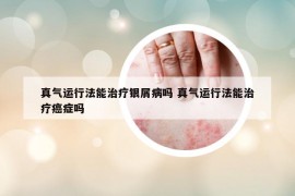 真气运行法能治疗银屑病吗 真气运行法能治疗癌症吗