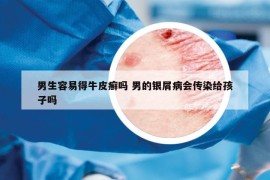 男生容易得牛皮癣吗 男的银屑病会传染给孩子吗