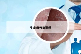 牛皮癣传染那吗