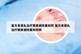 复方青黛丸治疗银屑病效果如何 复方青黛丸治疗银屑病效果如何啊