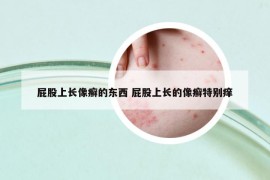 屁股上长像癣的东西 屁股上长的像癣特别痒