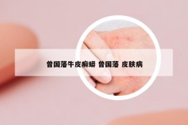 曾国藩牛皮癣蟒 曾国藩 皮肤病