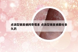点滴型银屑病阿奇霉素 点滴型银屑病要吃多久药