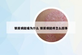 银屑病腿痛为什么 银屑病腿疼怎么回事