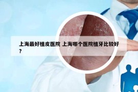 上海最好植皮医院 上海哪个医院植牙比较好?