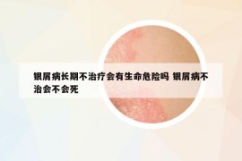 银屑病长期不治疗会有生命危险吗 银屑病不治会不会死