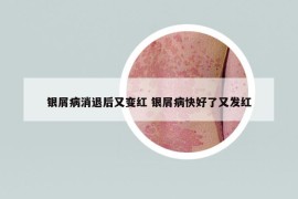 银屑病消退后又变红 银屑病快好了又发红