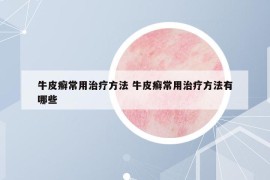 牛皮癣常用治疗方法 牛皮癣常用治疗方法有哪些