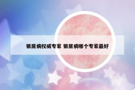 银屑病权威专家 银屑病哪个专家最好