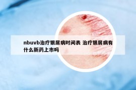 nbuvb治疗银屑病时间表 治疗银屑病有什么新药上市吗