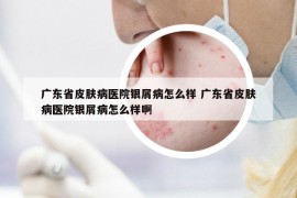 广东省皮肤病医院银屑病怎么样 广东省皮肤病医院银屑病怎么样啊