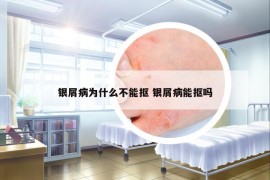 银屑病为什么不能抠 银屑病能抠吗