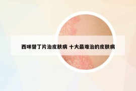 西咪替丁片治皮肤病 十大最难治的皮肤病