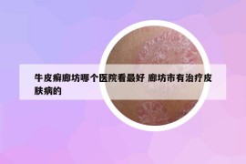 牛皮癣廊坊哪个医院看最好 廊坊市有治疗皮肤病的
