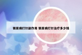 银屑病打针副作用 银屑病打针治疗多少钱