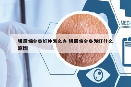 银屑病全身红肿怎么办 银屑病全身发红什么原因