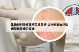 生物制剂治疗脓疱型银屑病 生物制剂治疗脓疱型银屑病的原理