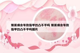 银屑病会导致指甲凹凸不平吗 银屑病会导致指甲凹凸不平吗图片