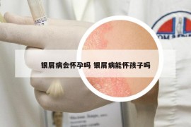 银屑病会怀孕吗 银屑病能怀孩子吗