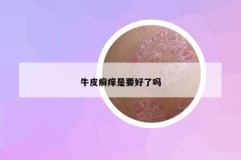 牛皮癣痒是要好了吗