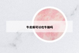 牛皮癣可以吃牛腩吗